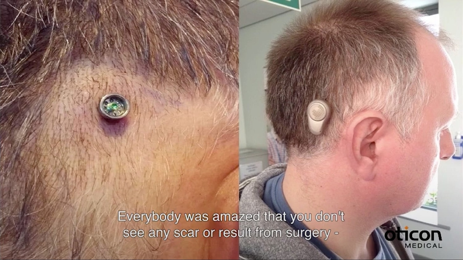 Before and after of implant surgery outcome.