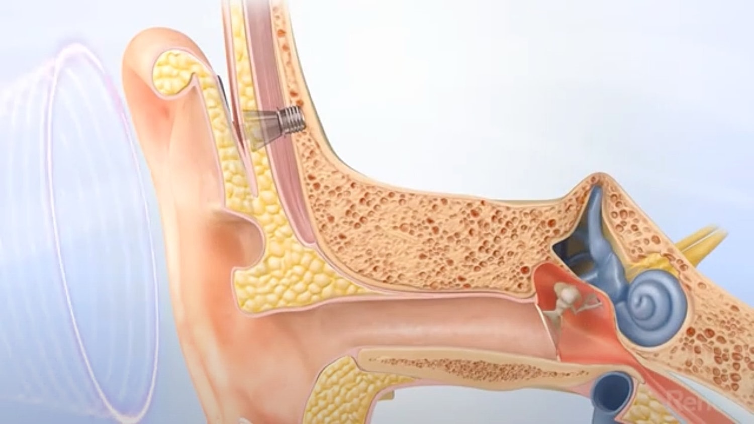 Illustration of human ear anatomy and sound transmission.